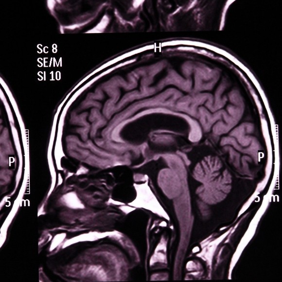 Brain tumor risk factors: are we any closer? - Oncology Central