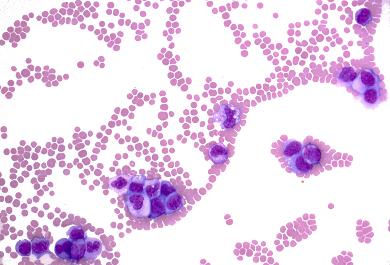 What is the average life expectancy for people with leukemia?
