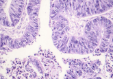 esophageal cancer