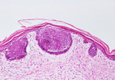 renal cell carcinoma