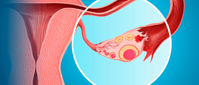 olaparib bevacizumab combination