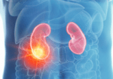renal cell carcinoma