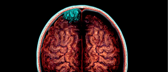 brain injury