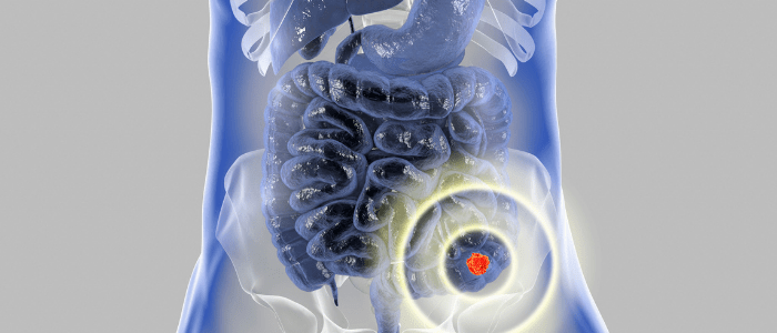colonoscopy