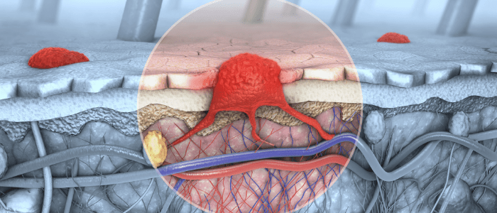 Neoadjuvant drug therapy