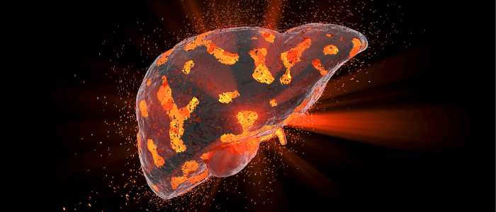 liver cancer screening