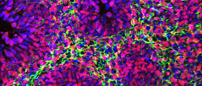 cancer cell, cancer, oncology