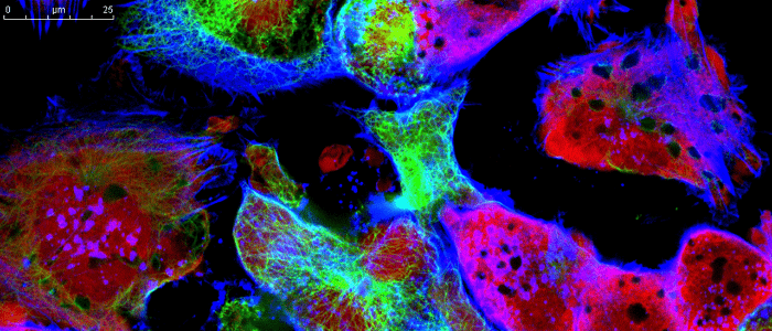 osteosarcoma, cancer cell, tumor