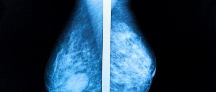 breast cancer screening