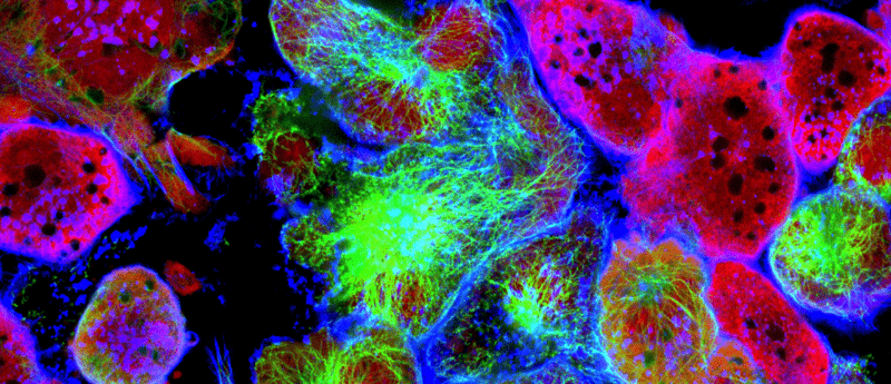 ginny mason breast cancer ibc research foundation