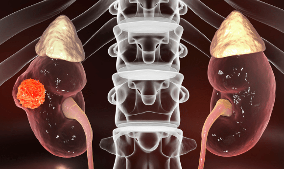 renal cell carcinoma