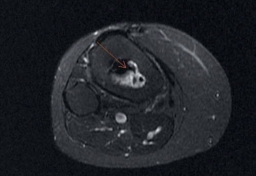 Avascular necrosis