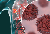 Here, we summarize the initial results from the ADAURA clinical study looking at treatment with osimertinib in patients with a specific type of non-small cell lung cancer