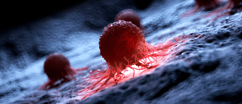 tenosynovial giant cell tumor