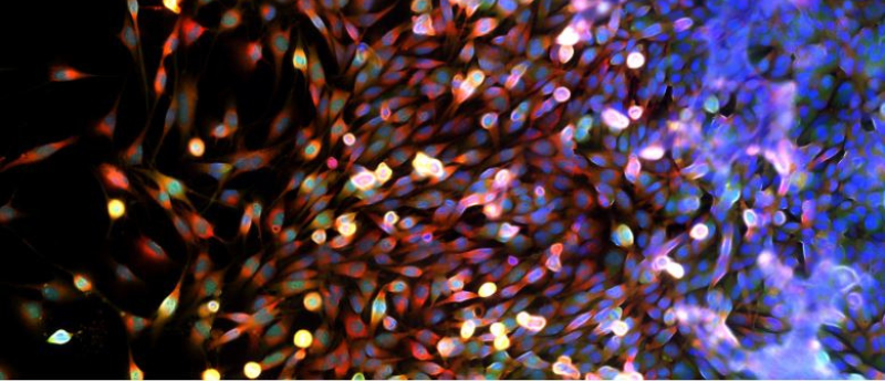 glioblastoma multiforme