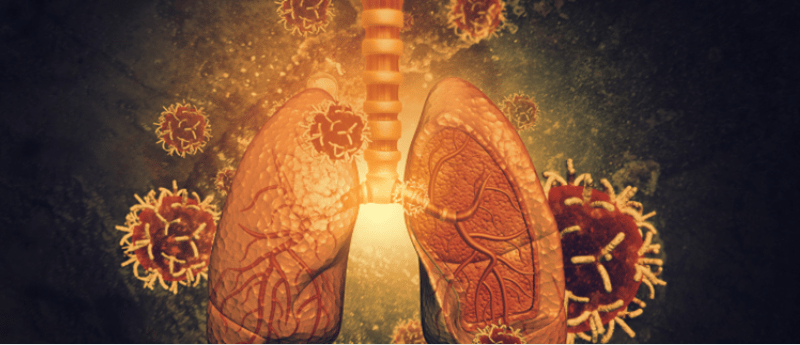 lung cancer screening UK