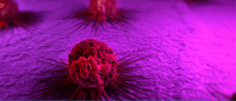 Pulmonary metastatic melanoma
