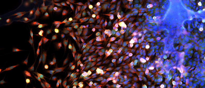 brain tumor