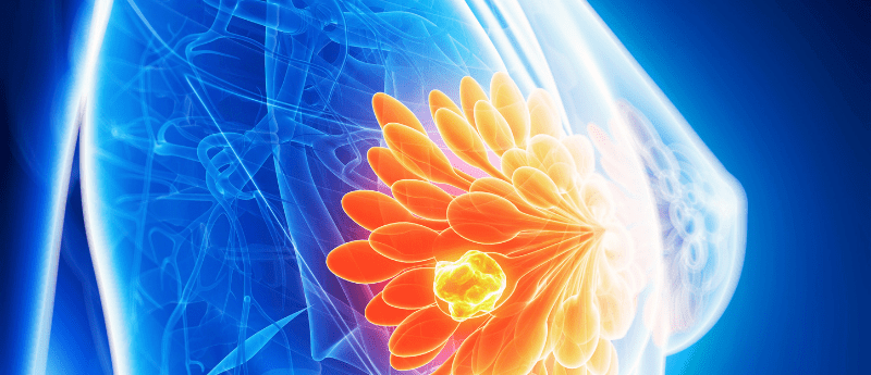 breast cancer rare subtypes