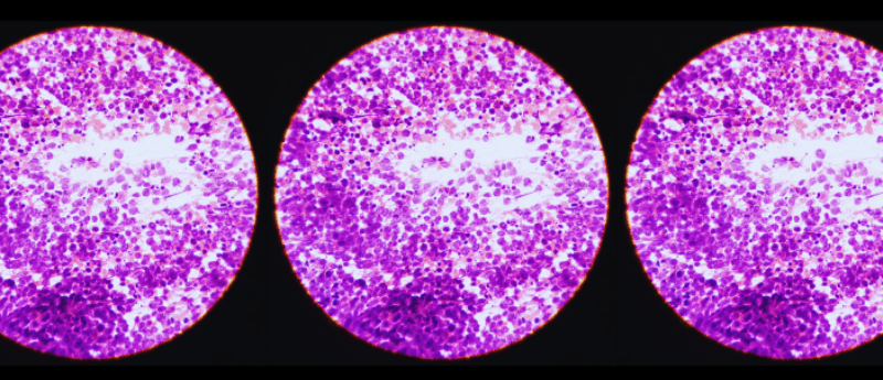 kidney cancer
