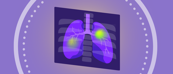 treatment-resistant nsclc